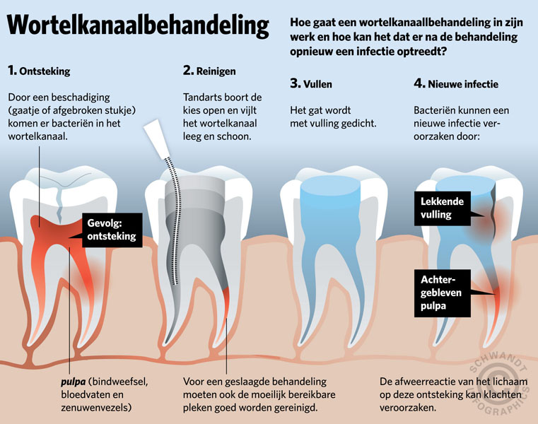 Wortelkanaalbehandeling